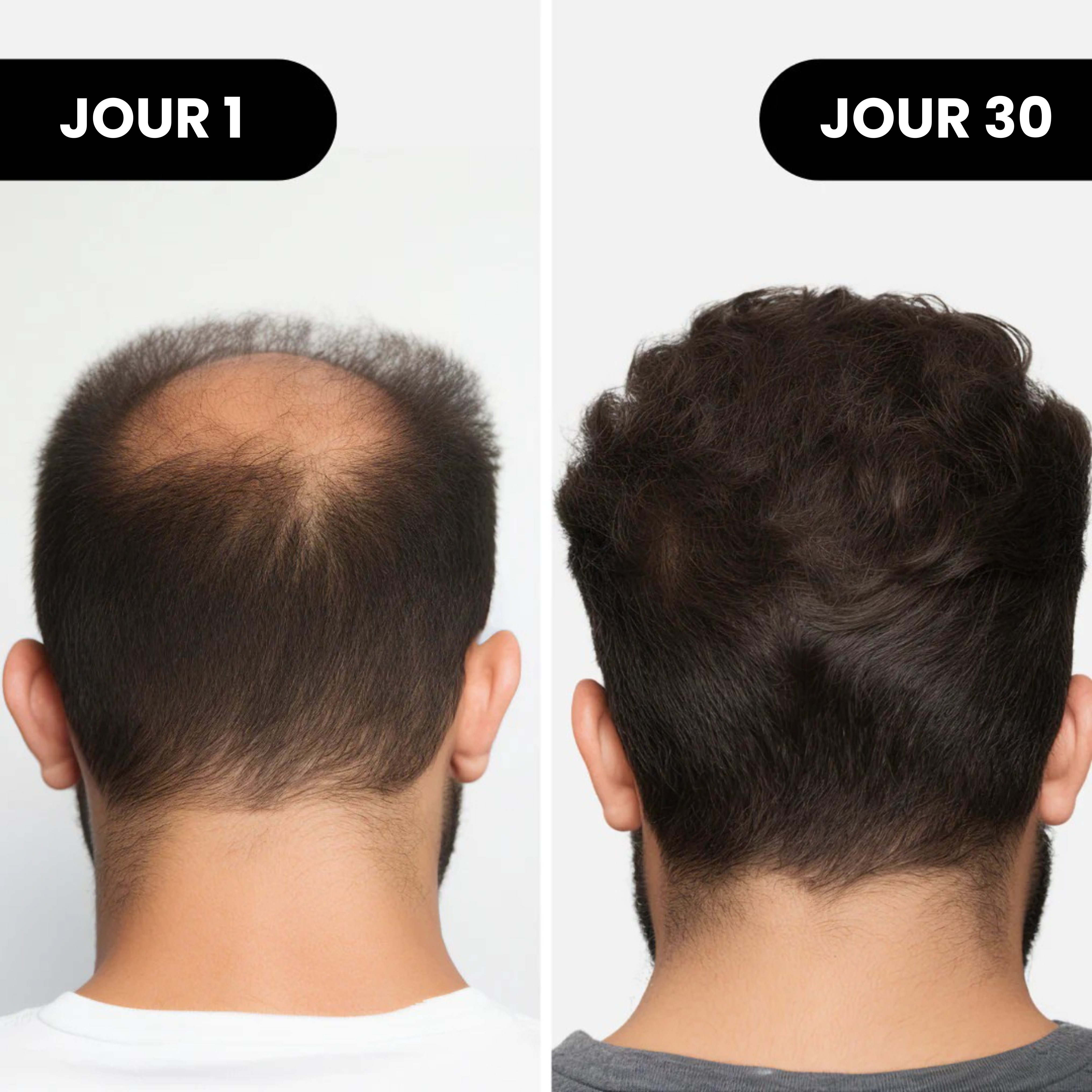 Renewal™ Repousse Des Cheveux
