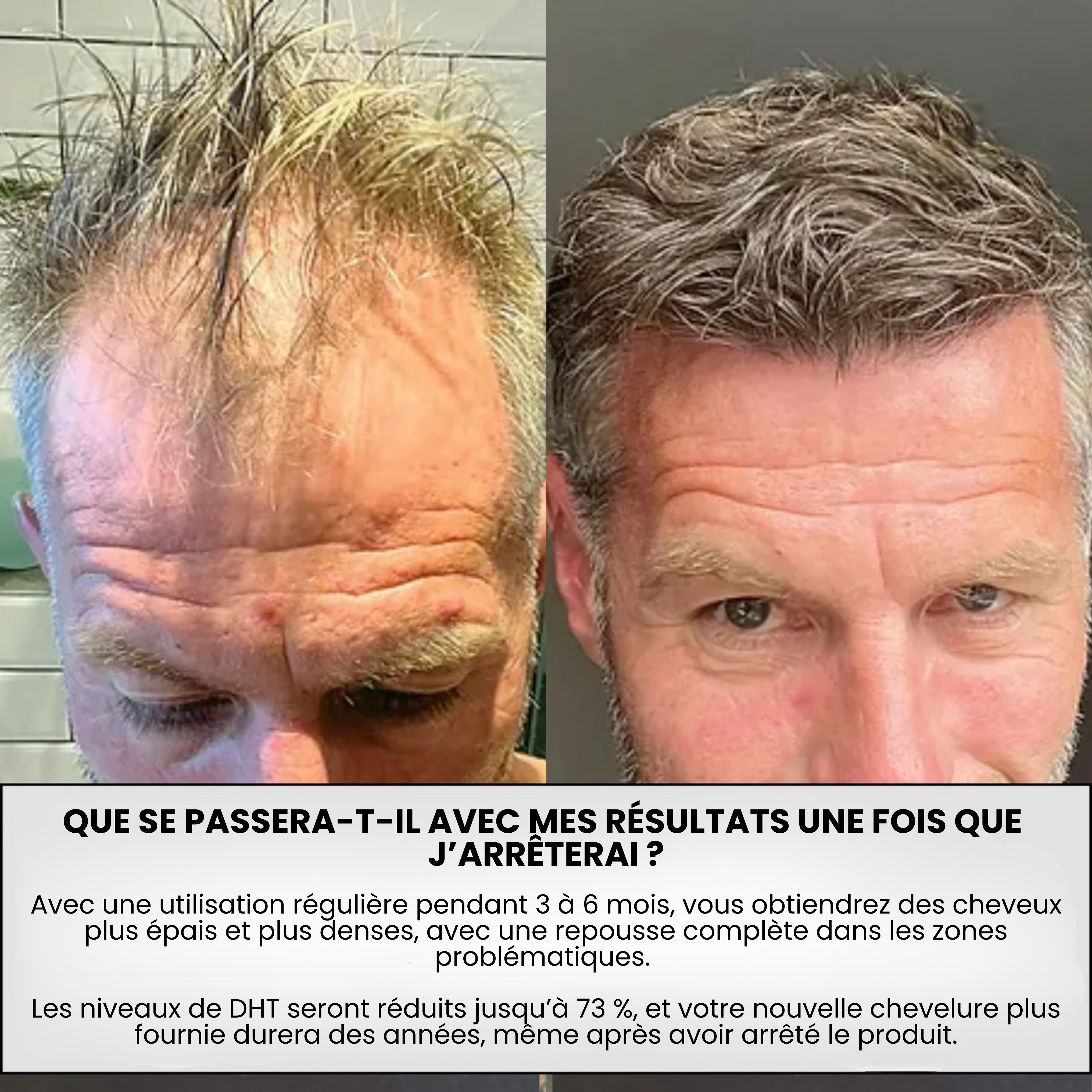 Renewal™ Repousse Des Cheveux